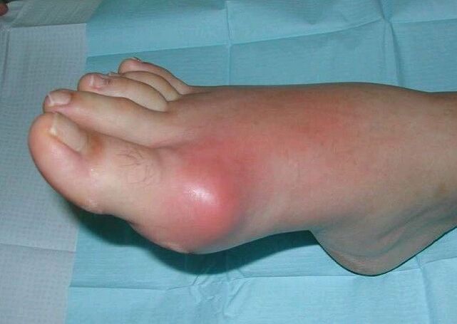 Klinisches Bild der Fußarthritis – Schwellung und Entzündung