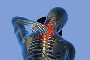 Symptome einer zervikalen Osteochondrose