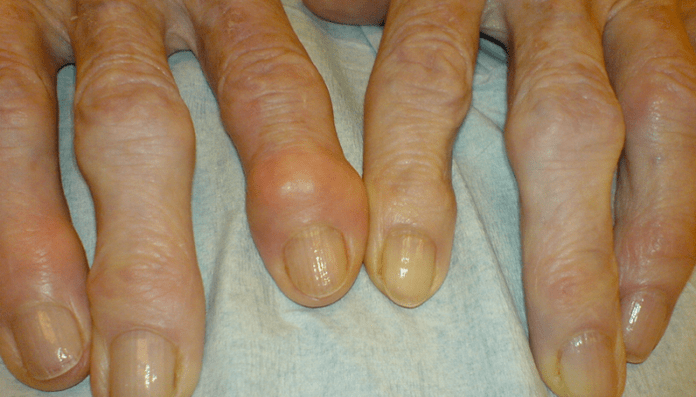 Schmerzen in den Fingergelenken bei Arthrose