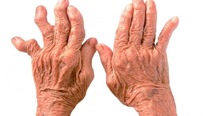 rheumatoide Arthritis als Ursache für Schmerzen in den Fingergelenken
