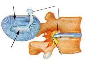 Zerstörung des Faserrings bei zervikaler Osteochondrose