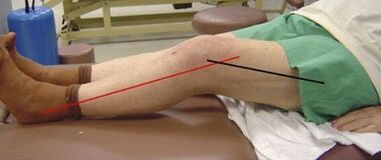 Progressive Arthrose des Kniegelenks