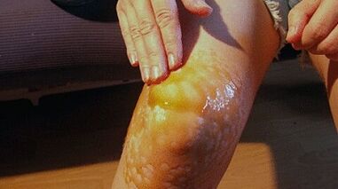 Rubbings zur Behandlung der Arthrose des Kniegelenks