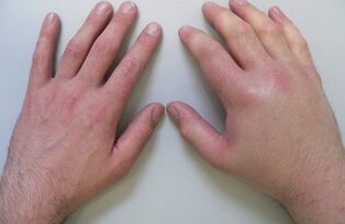 Arthralgie als Ursache von Schmerzen in den Fingergelenken
