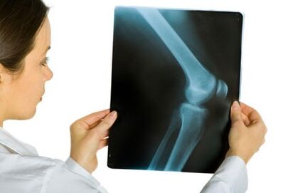 Behandlung der Arthrose des Kniegelenks