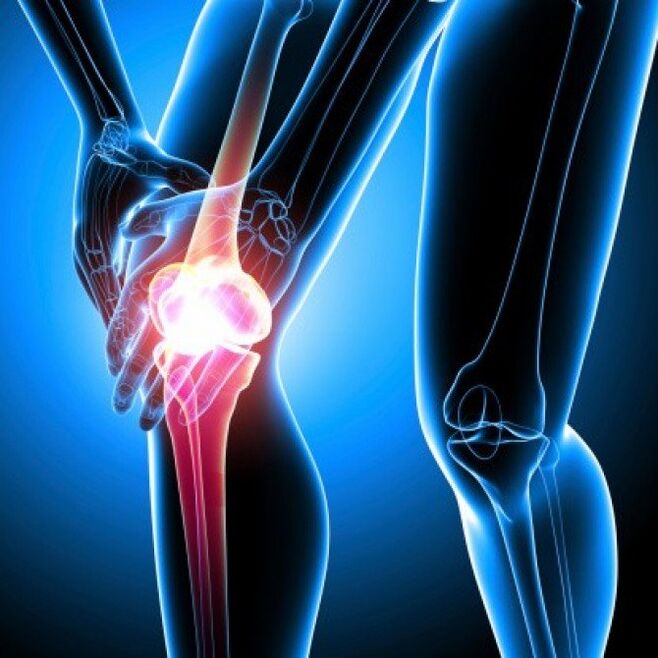 Rheumatoide Arthritis im fortgeschrittenen Stadium kann Hüftschmerzen verursachen